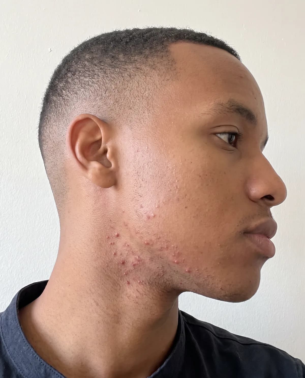 Before: a young man's jaw and neck, photographed in daylight